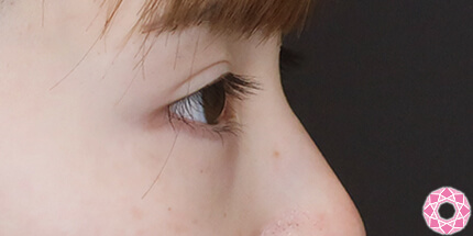 年代：20代 施術名：ジュビダーム 施術前｜【公式】東京形成美容外科