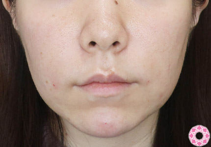 年代：30代 施術名：ジュビダーム 施術後｜【公式】東京形成美容外科