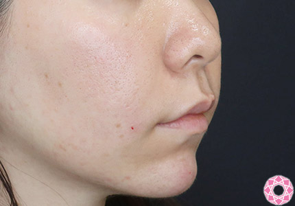 年代：30代 施術名：ジュビダーム 施術後｜【公式】東京形成美容外科