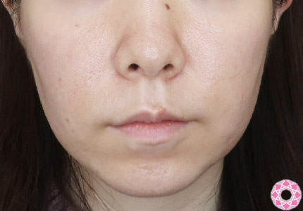 年代：30代 施術名：ジュビダーム 施術前｜【公式】東京形成美容外科