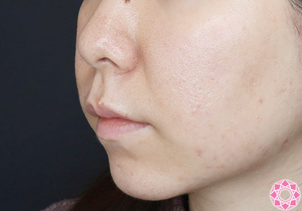 年代：30代 施術名：ジュビダーム 施術前｜【公式】東京形成美容外科