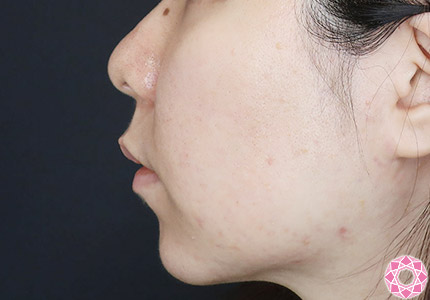 年代：30代 施術名：ジュビダーム 施術前｜【公式】東京形成美容外科