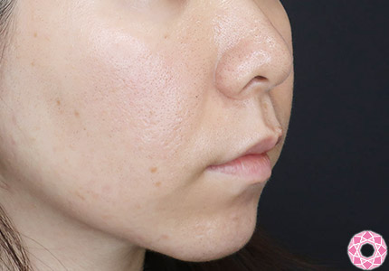 年代：30代 施術名：ジュビダーム 施術前｜【公式】東京形成美容外科