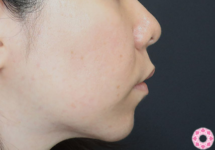 年代：30代 施術名：ジュビダーム 施術前｜【公式】東京形成美容外科