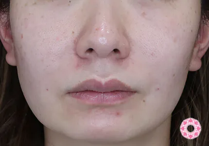 年代：40代 施術名：ジュビダーム 施術後｜【公式】東京形成美容外科