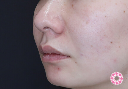 年代：40代 施術名：ジュビダーム 施術後｜【公式】東京形成美容外科