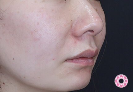 年代：40代 施術名：ジュビダーム 施術後｜【公式】東京形成美容外科