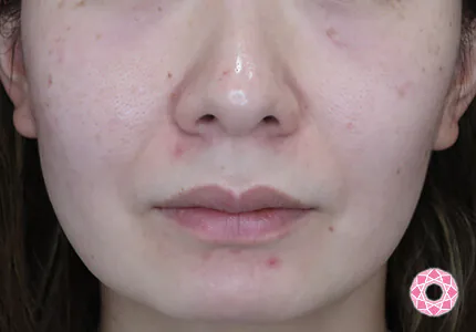 年代：40代 施術名：ジュビダーム 施術前｜【公式】東京形成美容外科