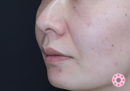 年代：40代 施術名：ジュビダーム 施術前｜【公式】東京形成美容外科