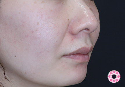 年代：40代 施術名：ジュビダーム 施術前｜【公式】東京形成美容外科