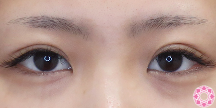 年代：20代 施術名：二重埋没法 施術後｜【公式】東京形成美容外科