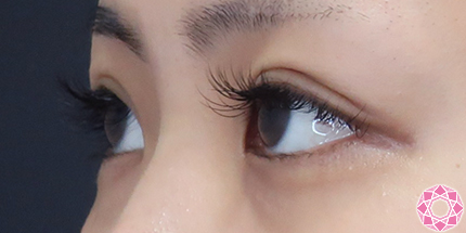 年代：20代 施術名：二重埋没法 施術後｜【公式】東京形成美容外科