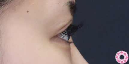 年代：20代 施術名：二重埋没法 施術後｜【公式】東京形成美容外科