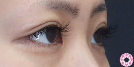 年代：20代 施術名：二重埋没法 施術後｜【公式】東京形成美容外科