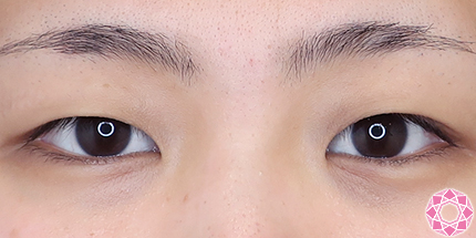 年代：20代 施術名：二重埋没法 施術前｜【公式】東京形成美容外科