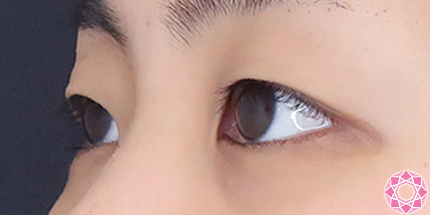 年代：20代 施術名：二重埋没法 施術前｜【公式】東京形成美容外科