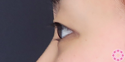 年代：20代 施術名：二重埋没法 施術前｜【公式】東京形成美容外科