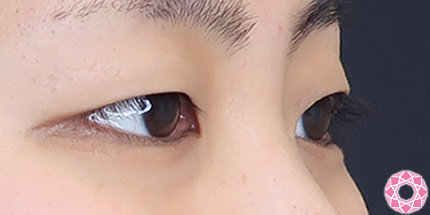 年代：20代 施術名：二重埋没法 施術前｜【公式】東京形成美容外科