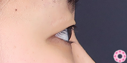 年代：20代 施術名：二重埋没法 施術前｜【公式】東京形成美容外科