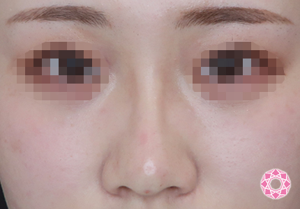 年代：20代 施術名：プチ隆鼻術（ヒアルロン酸） 施術後｜【公式】東京形成美容外科