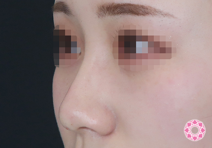 年代：20代 施術名：プチ隆鼻術（ヒアルロン酸） 施術後｜【公式】東京形成美容外科