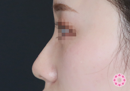 年代：20代 施術名：プチ隆鼻術（ヒアルロン酸） 施術後｜【公式】東京形成美容外科