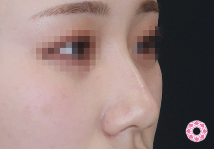 年代：20代 施術名：プチ隆鼻術（ヒアルロン酸） 施術後｜【公式】東京形成美容外科