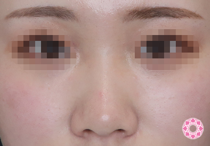 年代：20代 施術名：プチ隆鼻術（ヒアルロン酸） 施術前｜【公式】東京形成美容外科