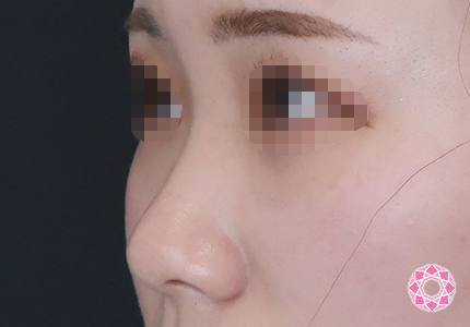 年代：20代 施術名：プチ隆鼻術（ヒアルロン酸） 施術前｜【公式】東京形成美容外科