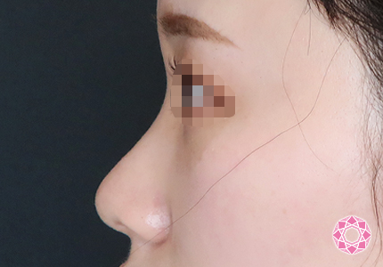 年代：20代 施術名：プチ隆鼻術（ヒアルロン酸） 施術前｜【公式】東京形成美容外科