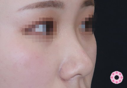 年代：20代 施術名：プチ隆鼻術（ヒアルロン酸） 施術前｜【公式】東京形成美容外科