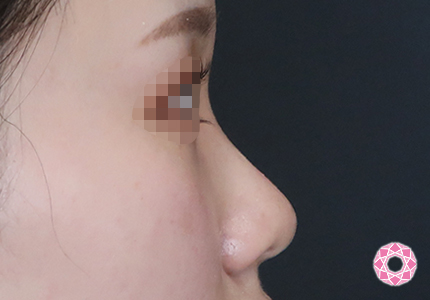 年代：20代 施術名：プチ隆鼻術（ヒアルロン酸） 施術前｜【公式】東京形成美容外科