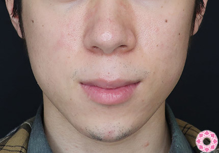 年代：20代 施術名：ジュビダーム 施術後｜【公式】東京形成美容外科