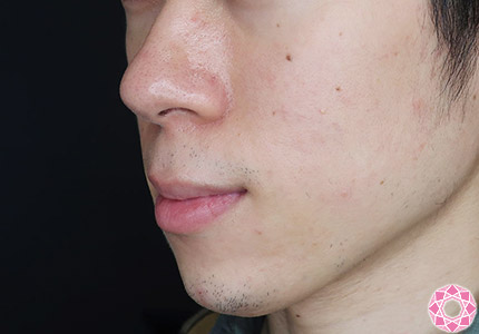 年代：20代 施術名：ジュビダーム 施術後｜【公式】東京形成美容外科