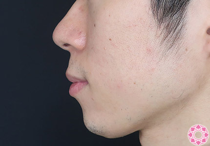 年代：20代 施術名：ジュビダーム 施術後｜【公式】東京形成美容外科