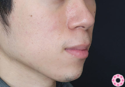 年代：20代 施術名：ジュビダーム 施術後｜【公式】東京形成美容外科