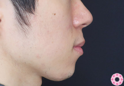 年代：20代 施術名：ジュビダーム 施術後｜【公式】東京形成美容外科