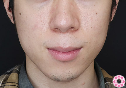 年代：20代 施術名：ジュビダーム 施術前｜【公式】東京形成美容外科