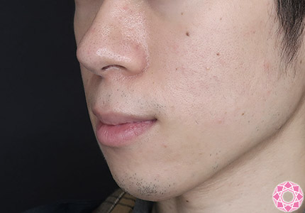 年代：20代 施術名：ジュビダーム 施術前｜【公式】東京形成美容外科