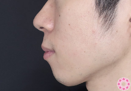 年代：20代 施術名：ジュビダーム 施術前｜【公式】東京形成美容外科