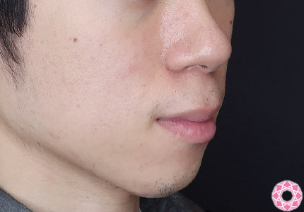 年代：20代 施術名：ジュビダーム 施術前｜【公式】東京形成美容外科