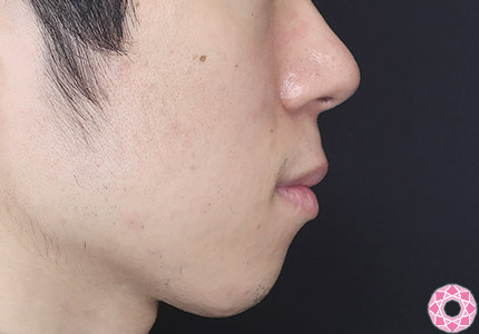 年代：20代 施術名：ジュビダーム 施術前｜【公式】東京形成美容外科