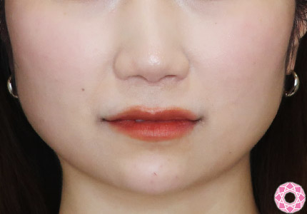年代：30代 施術名：ジュビダーム 施術後｜【公式】東京形成美容外科