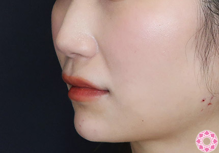 年代：30代 施術名：ジュビダーム 施術後｜【公式】東京形成美容外科