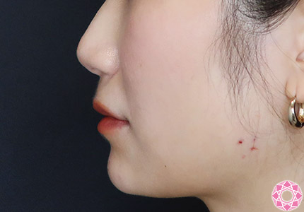 年代：30代 施術名：ジュビダーム 施術後｜【公式】東京形成美容外科