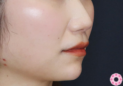 年代：30代 施術名：ジュビダーム 施術後｜【公式】東京形成美容外科