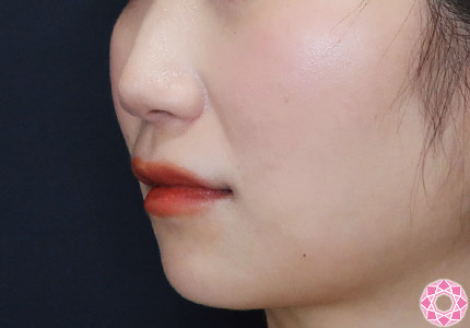 年代：30代 施術名：ジュビダーム 施術前｜【公式】東京形成美容外科