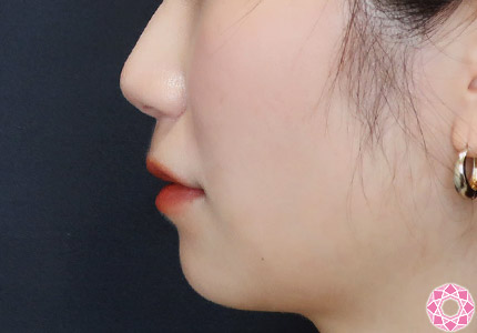 年代：30代 施術名：ジュビダーム 施術前｜【公式】東京形成美容外科