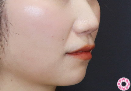 年代：30代 施術名：ジュビダーム 施術前｜【公式】東京形成美容外科