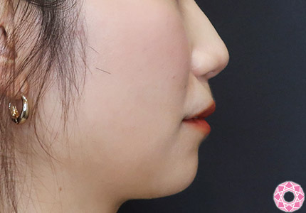 年代：30代 施術名：ジュビダーム 施術前｜【公式】東京形成美容外科